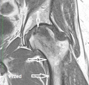 Hip Before Treatment